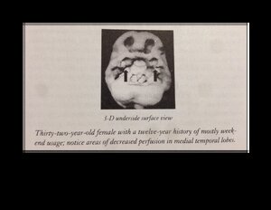 Marijuana-affected-Brains-Underside-View2.pdf