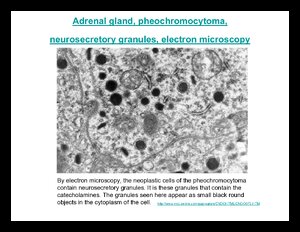 Pheochromocytoma.pdf